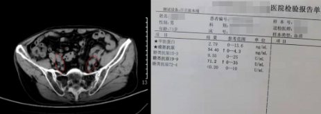 膀胱癌患者重获新生的真实案例